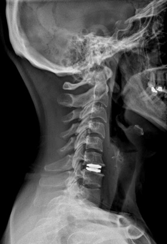 boyun fıtığında disk protezi ne işe yarar